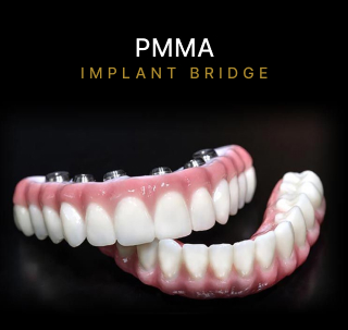 PMMA Implant Bridge