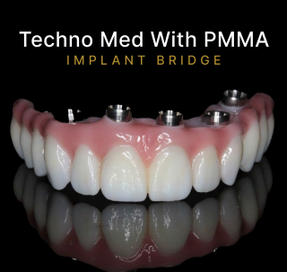 Techno Med With PMMA Implant Bridge