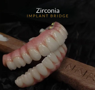 Zirconia Implant Bridge